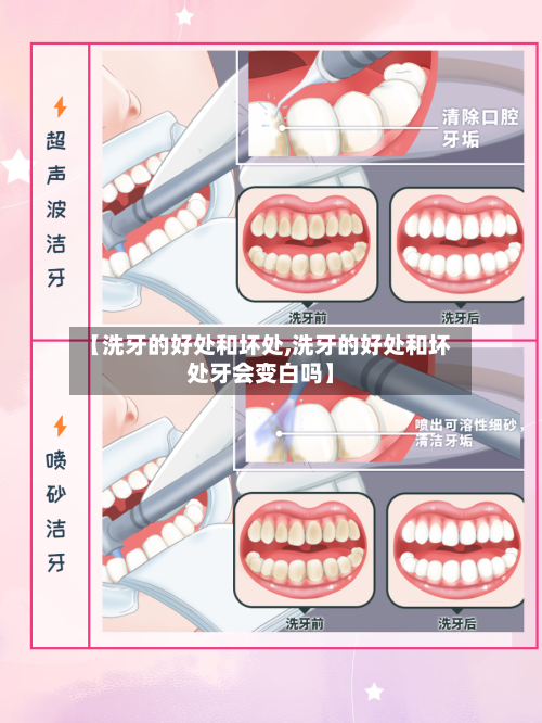 【洗牙的好处和坏处,洗牙的好处和坏处牙会变白吗】