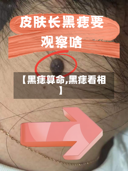 【黑痣算命,黑痣看相】-第2张图片